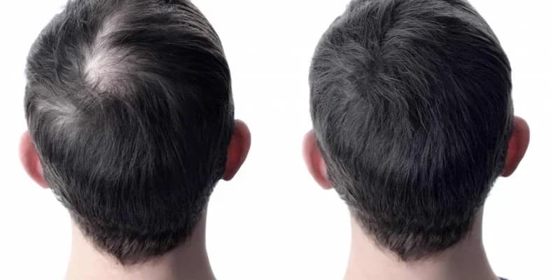 علاج تساقط الشعر